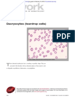 Blood: Dacryocytes (Teardrop Cells)