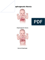 Diaphragmatic Hernia