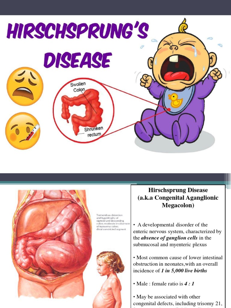 Hirschsprung Disease | Download Free PDF | Rectum | Gastroenterology