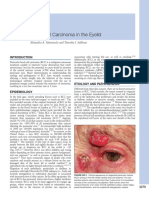 CA Basocelular