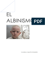 Los tipos y síntomas del albinismo