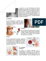 La Neumonía, ASMA LARINGUITIS, DIFTERIA