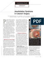 Pseudoexfoliation Syndrome in Cataract Surgery: Ophthalmic Pearls