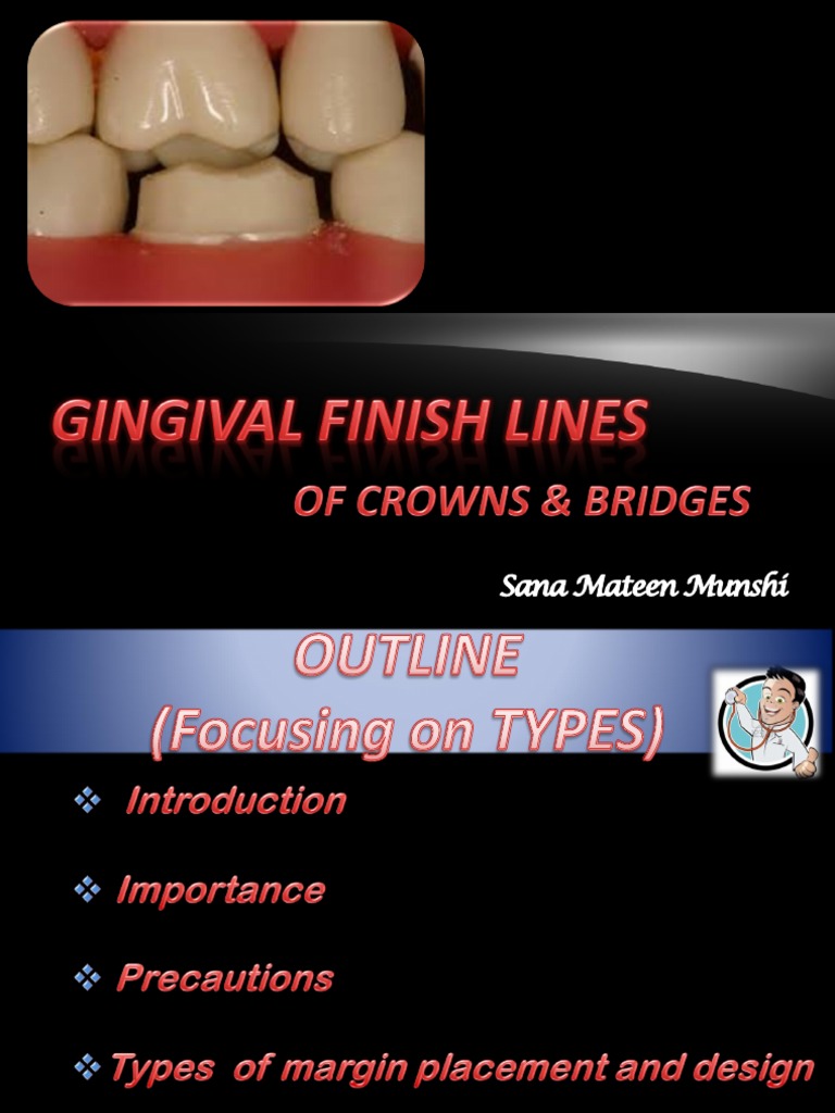 Finish Lines in FPD PDF Mouth Dentistry