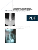 Trastornos Del Esofago