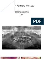 Anodoncia de Germenes Dentarios Permanentes