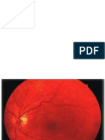 retinopati diabetikum