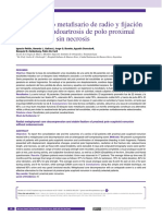 Bloqueo Óseo Metafisario de Radio y Fijación Estable en Seudoartrosis de Polo Proximal de Escafoides Sin Necrosis.