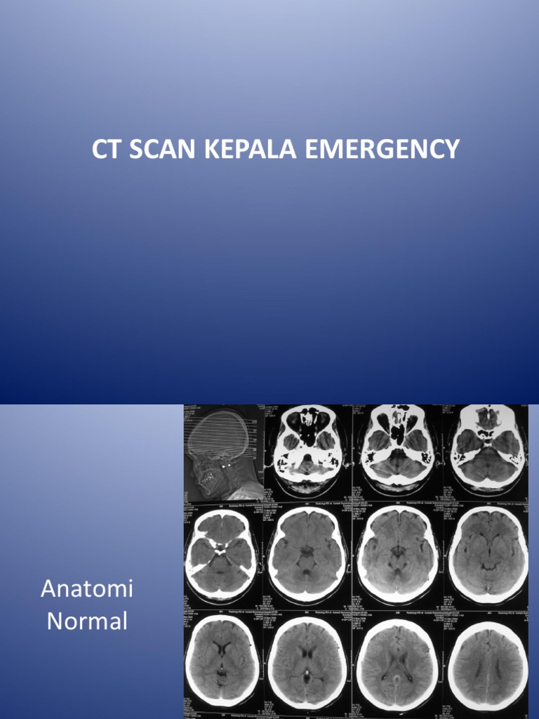 CT Scan Kepala Emergency | PDF