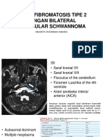 Neurofibromatosis Tipe 2 Dengan Bilateral Vestibular Schwannoma