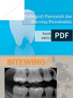 Gambar radiografi denga bone loss (periodontitis)