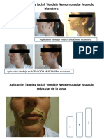 Aplicación Tapping Facial Vendaje Neuromuscular Musculo Masetero