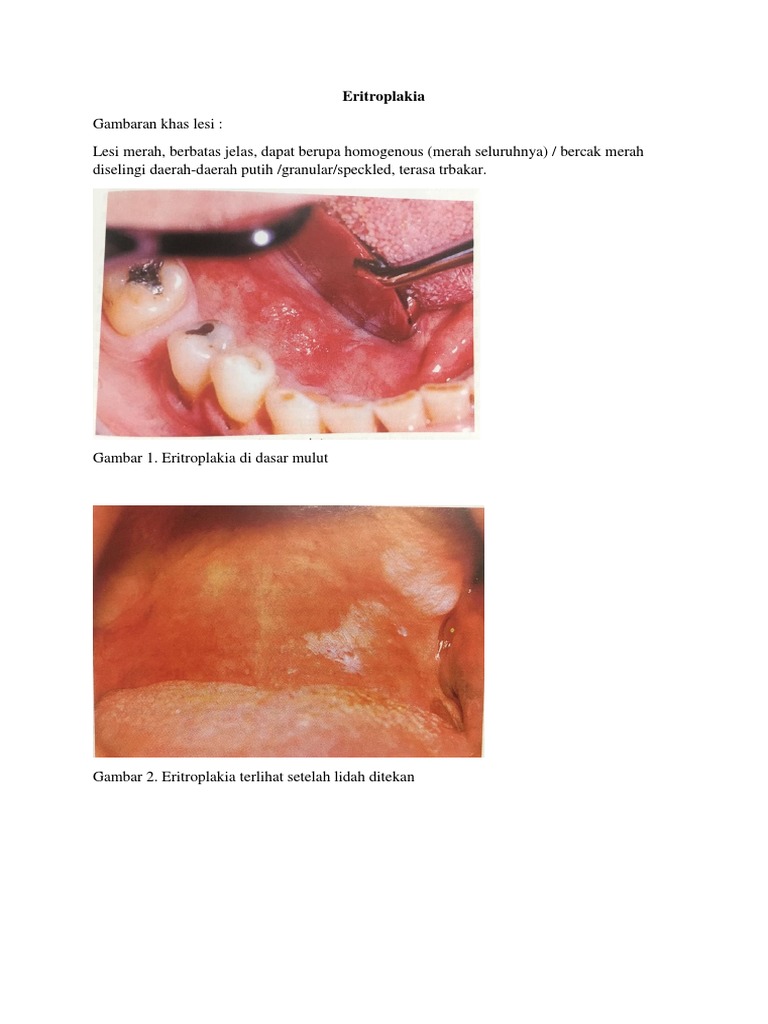 Eritroplakia | PDF