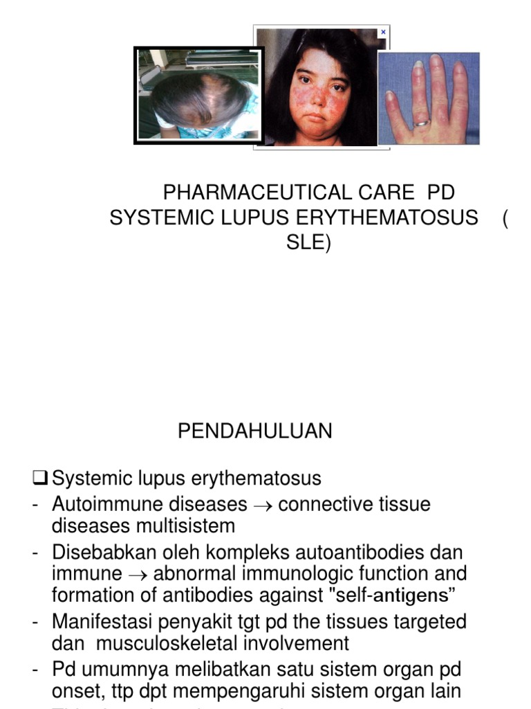 PHARM CARE PD SLE New | PDF | Systemic Lupus Erythematosus | Medical ...