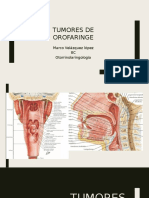 Tumores de Orofaringe