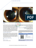 Sutural Cataract Ophthalmic Images