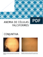 Anemia células falciformes conjuntiva