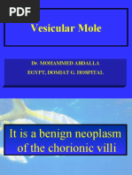 Vesicular Mole: Dr. Mohammed Abdalla Egypt, Domiat G. Hospital