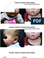 Acute Irritant Contact Dermatitis