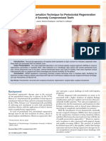 A New Papilla Preservation Technique For Periodontal Regeneration of Severely Compromised Teeth