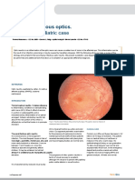 Report of A Pediatric Case: Neuritis Infectious Optics