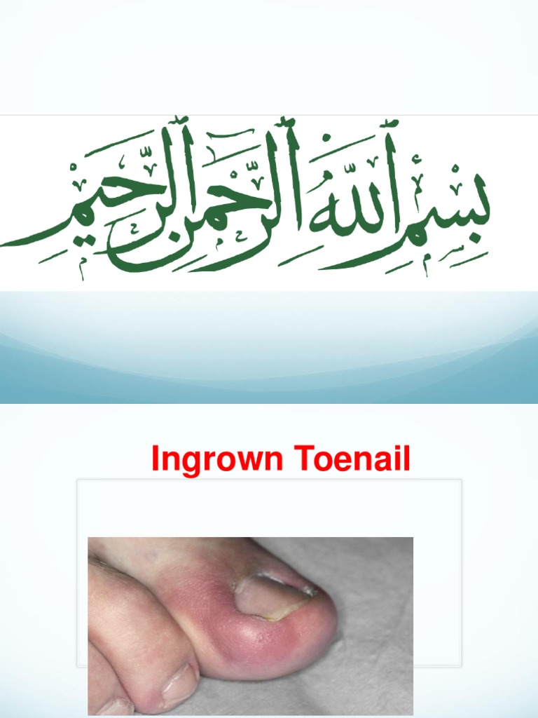 Ingrown Toenail PDF Nail (Anatomy) Medicine