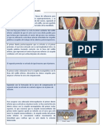 Dientes Post