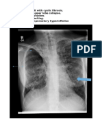 Thin Arrow: Right Upper Lobe Collapse. Thick Arrow: Ring Shadow. Fat Arrow: Tram Tracking. Double Arrow: Compensatory Hyperinflation