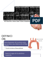 Coartación Aórtica