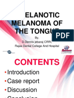 Rare Tongue Melanoma