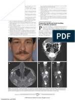 Progressive Eyelid and Facial Swelling Due To Follicular Lymphoma