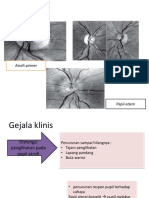 Papil Atrofi - Ringkasan Klasifikasi, Gejala, Diagnosis dan Penatalaksanaan