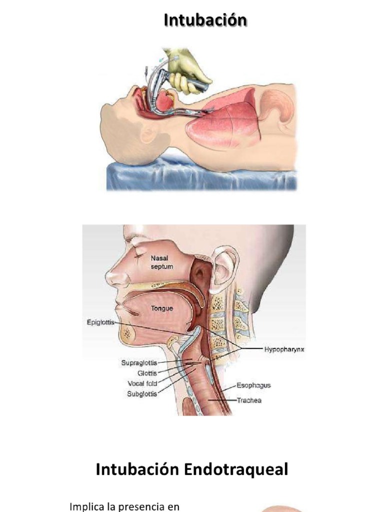 Intubación Endotraqueal | PDF
