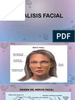 Paralisis Facial