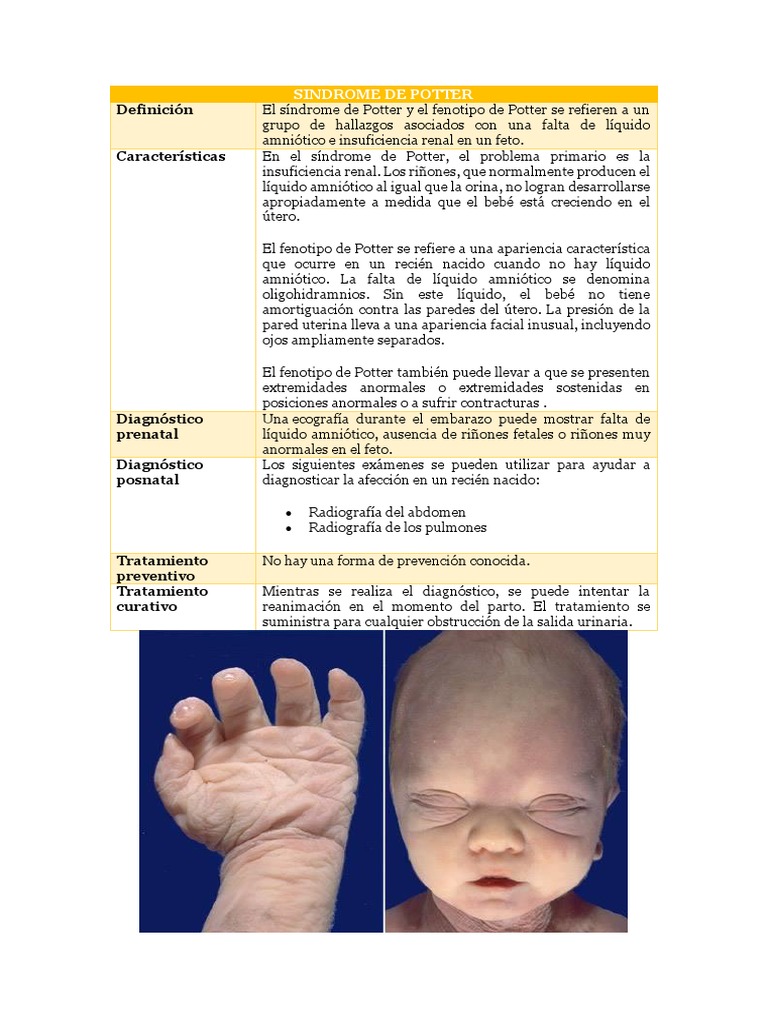 El síndrome de Potter una condición renal fetal rara caracterizada por