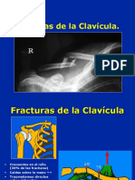 Acturas, Lux. Esguinces de ClavÃ-cula