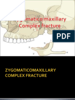 zmc fracture in oral surgery.pptx