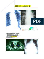 11 MEDIASTINO  - parte II.doc