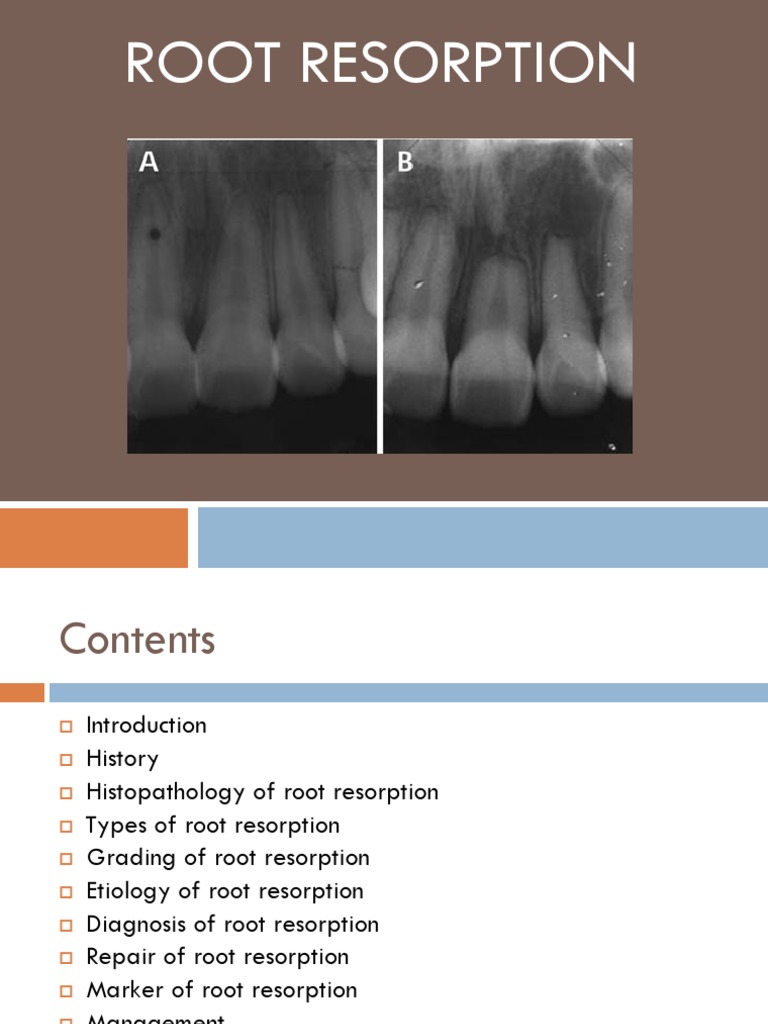 Root Resorption Human Tooth Mouth