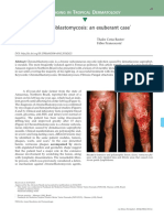 Chromoblastomycosis An Exuberant Case