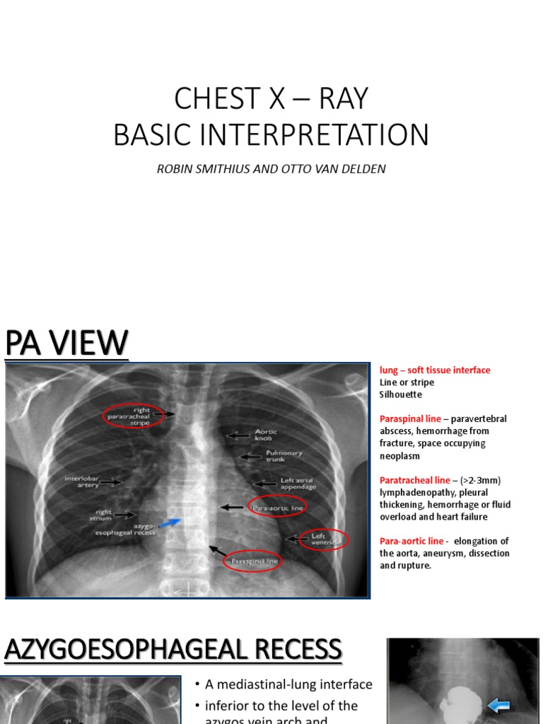 Chest X Ray PDF Heart Ventricle (Heart)