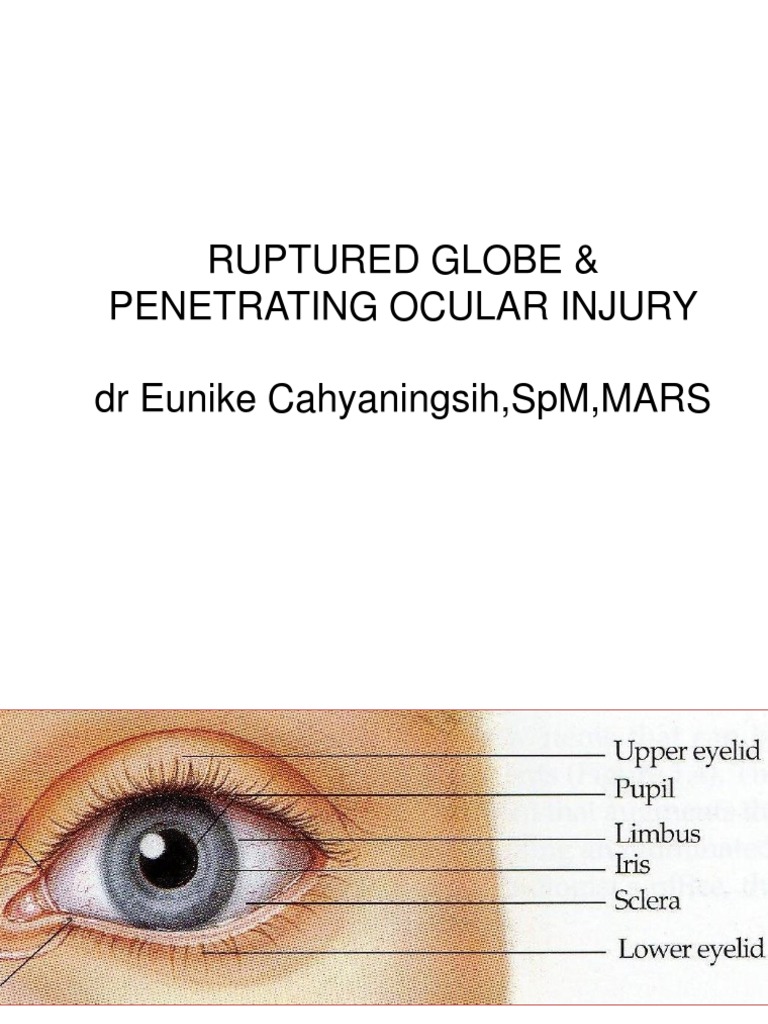 Ruptured Globe & Penetrating Ocular Injury DR Eunike Cahyaningsih, SPM ...