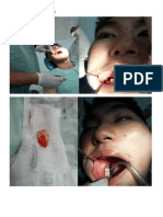 Impacted Tooth Removal