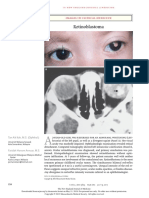 Retinoblastoma: Images in Clinical Medicine