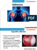 Capsulitis Adhesiva
