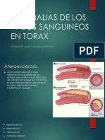 ANOMALIAS DE LOS VASOS SANGUINEOS EN TORAX [Autoguardado].pptx