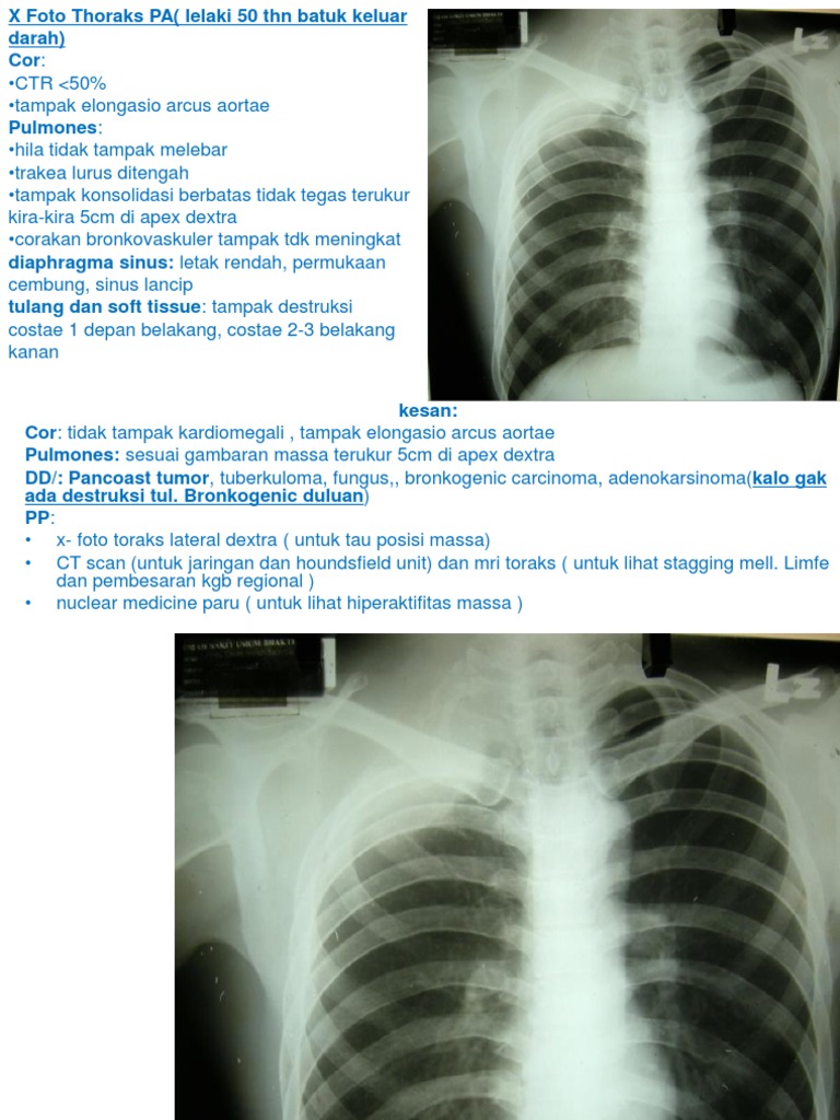 Analisis Rontgen Thoraks Pasien Dewasa | PDF | Perjalanan | Kajian ...