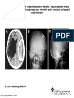 A. Kavčič Et Al. Neurology 2006 66:758: ©2006 by Lippincott Williams & Wilkins