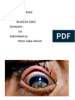 Keratomalacia Eye Disease