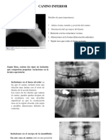 Canino inferior: extracción y complicaciones en